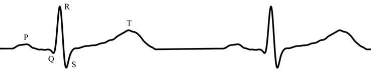 [example of ECG]